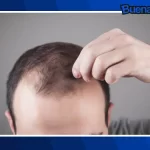 ¡Buena noticia! Adiós a la calvicie, investigadores españoles desarrollan innovadora terapia que podría acabar con la alopecia