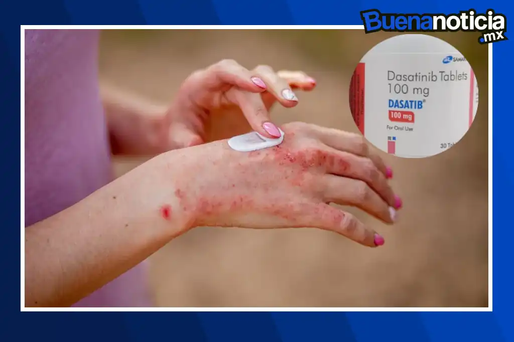 Buena noticia: Científicos descubren cómo un fármaco existente podría ayudar a pacientes con psoriasis